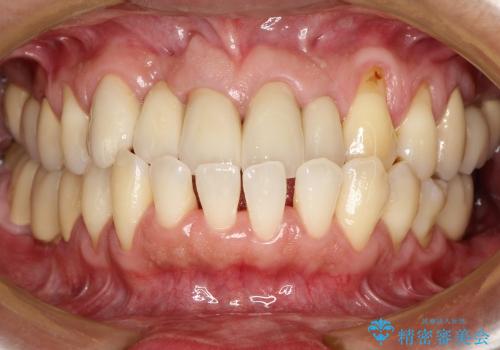 前歯　深い虫歯の治療の治療後