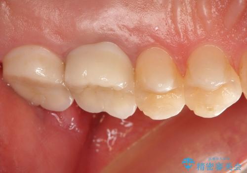 [金属アレルギー] 銀歯を外すセラミック審美歯科治療の治療後