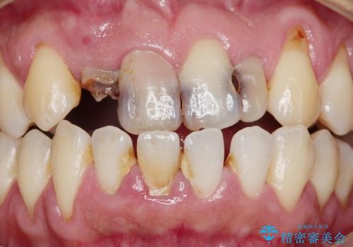 前歯　深い虫歯の治療の治療前