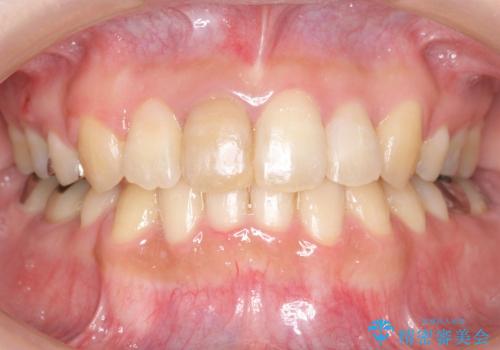 30代女性　3本で済んだ抜歯　過蓋(かがい)咬合の治療後