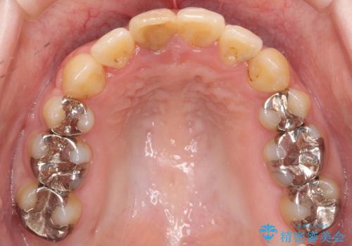 30代女性　3本で済んだ抜歯　過蓋(かがい)咬合の治療後
