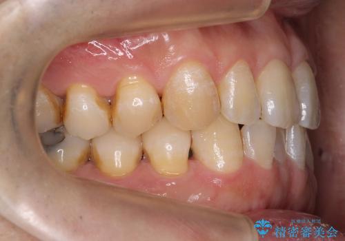 50代男性　部分矯正+銀歯を白く　若々しくの治療前