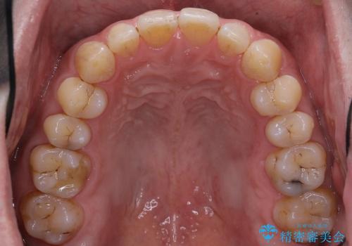 50代男性　部分矯正+銀歯を白く　若々しくの治療前