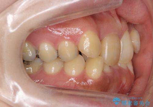 30代女性　3本で済んだ抜歯　過蓋(かがい)咬合の治療前