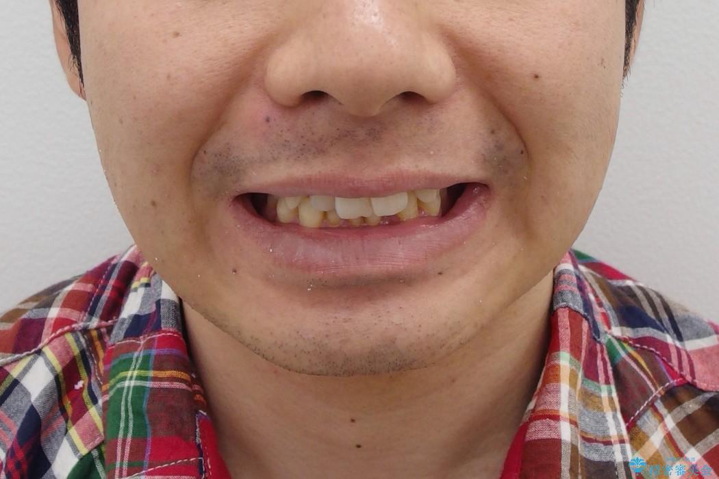 20代男性　歯のがたがた　爽やかスマイルにの治療前（顔貌）