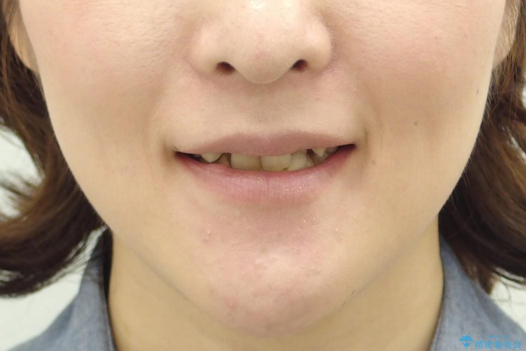 30代女性　3本で済んだ抜歯　過蓋(かがい)咬合の治療前（顔貌）