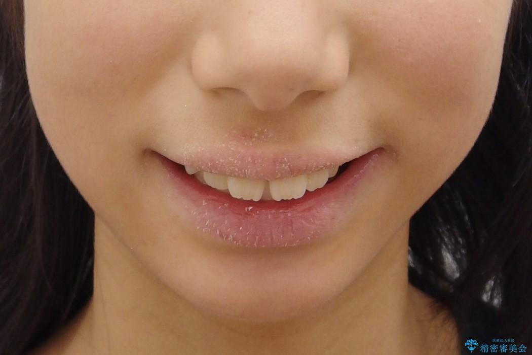 10代女性　出っ歯　の治療前（顔貌）