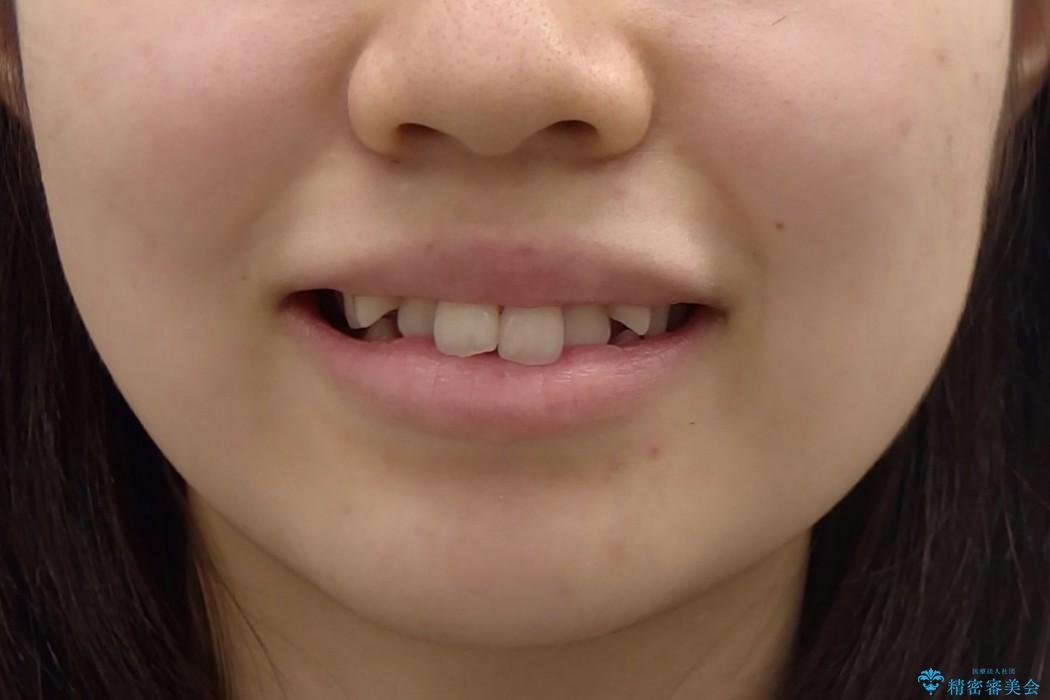 八重歯を1年で矯正の治療前（顔貌）