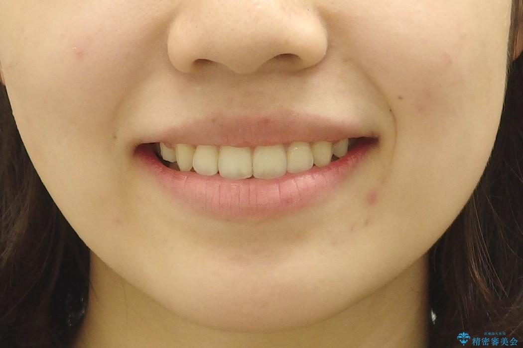 八重歯を1年で矯正の治療後（顔貌）