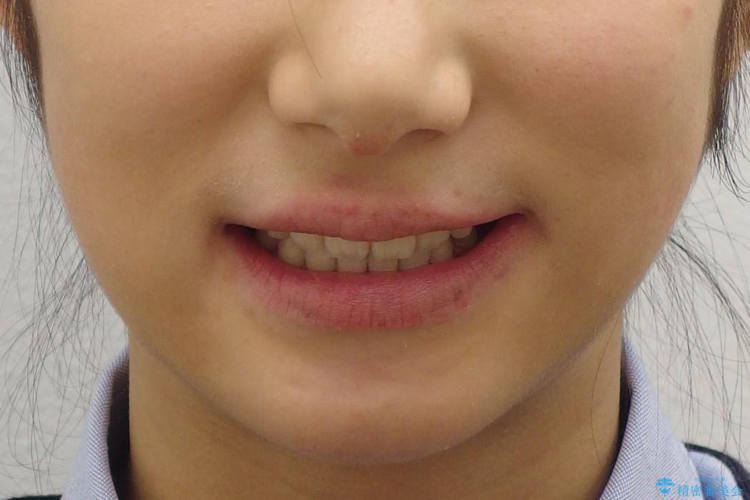 10代女性　出っ歯　の治療後（顔貌）