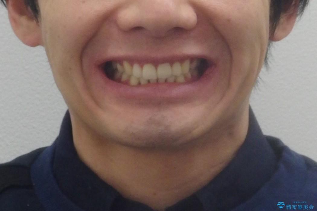 20代男性　歯のがたがた　爽やかスマイルにの治療後（顔貌）