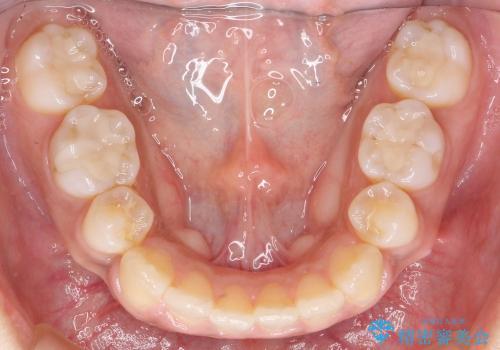30代女性　奥歯の銀歯をセラミックで白い歯にの治療後