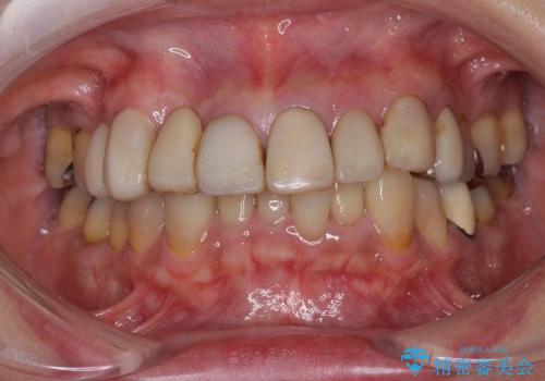 40代女性　変色したプラスチックの前歯をオールセラミックへの治療前