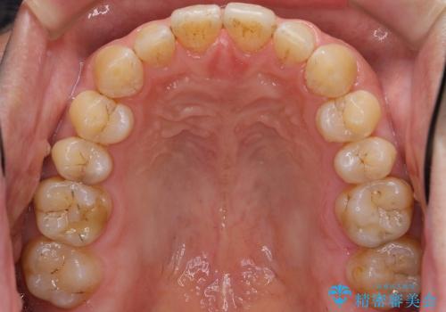 50代男性　部分矯正+銀歯を白く　若々しくの治療後