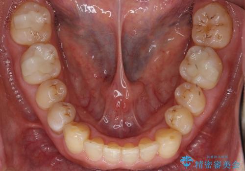 50代男性　部分矯正+銀歯を白く　若々しくの治療後