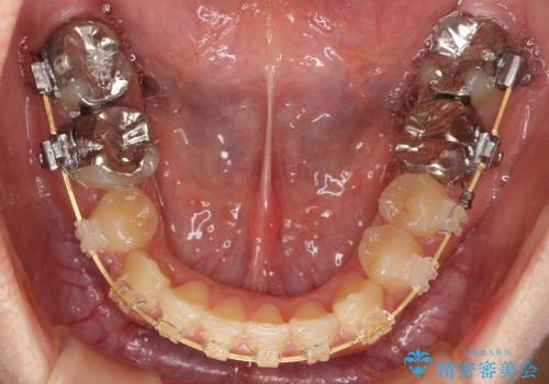 30代女性　3本で済んだ抜歯　過蓋(かがい)咬合の治療中