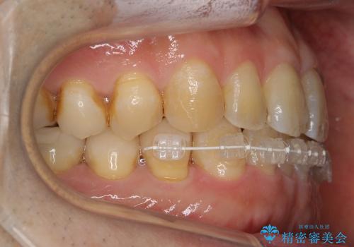 50代男性　部分矯正+銀歯を白く　若々しくの治療中