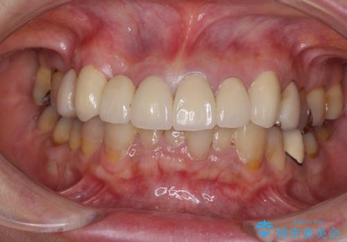40代女性　変色したプラスチックの前歯をオールセラミックへの治療後