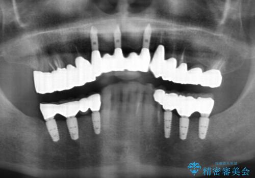 入れ歯をはずす全顎的インプラント治療の治療後