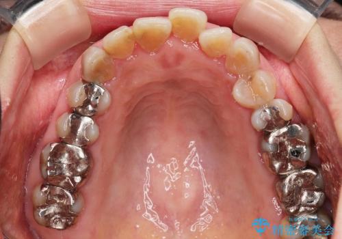 [変色歯・テトラサイクリン歯]  ジルコニアクラウンによる審美改善の治療前