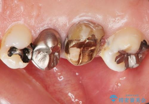 [金属アレルギー] 銀歯を外すセラミック審美歯科治療の治療前