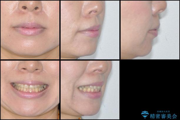40代女性　前歯のでこぼこをインビザラインでの治療前（顔貌）