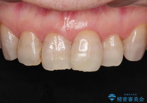 [変色歯・テトラサイクリン歯]  ジルコニアクラウンによる審美改善の治療前