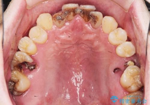 前歯　深い虫歯の治療の治療前