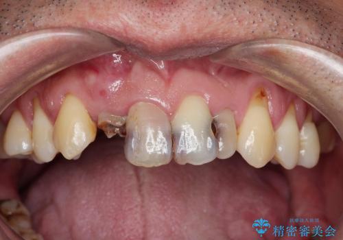 前歯　深い虫歯の治療