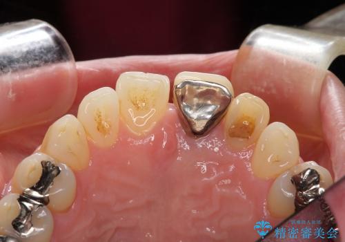 [歯肉の移植] 審美性を改善した前歯ブリッジ治療の治療前
