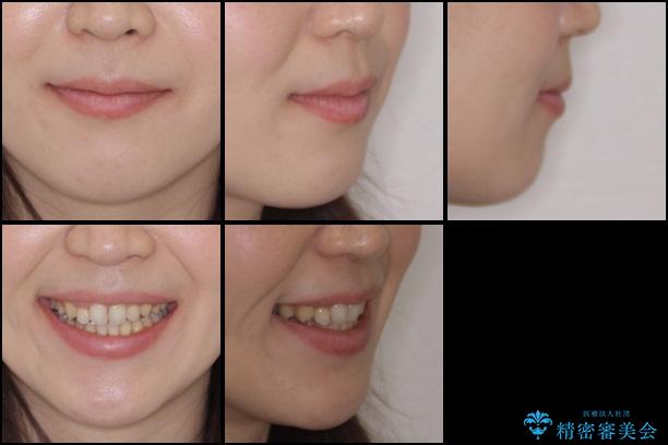 20代女性　八重歯を治したい　審美装置での抜歯矯正の治療後（顔貌）