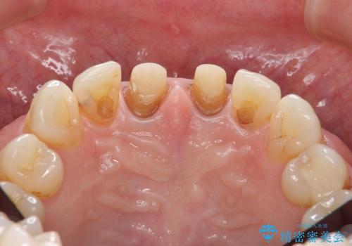 [感染根管治療] 根管治療を伴った前歯部精密審美治療の治療中