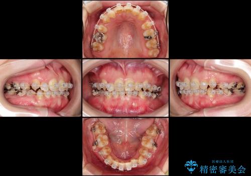 20代女性　八重歯を治したい　審美装置での抜歯矯正の治療中