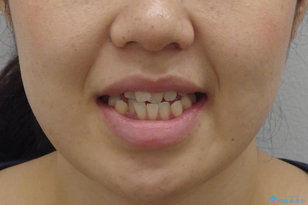 受け口　歯を抜かない矯正　わずか1年での治療前（顔貌）