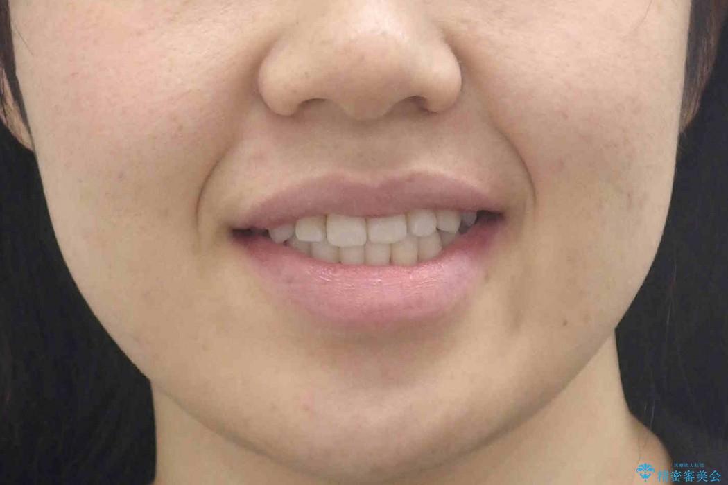 受け口　歯を抜かない矯正　わずか1年での治療後（顔貌）