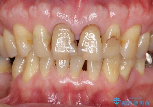 [感染根管治療] 根管治療を伴った前歯部精密審美治療の治療前