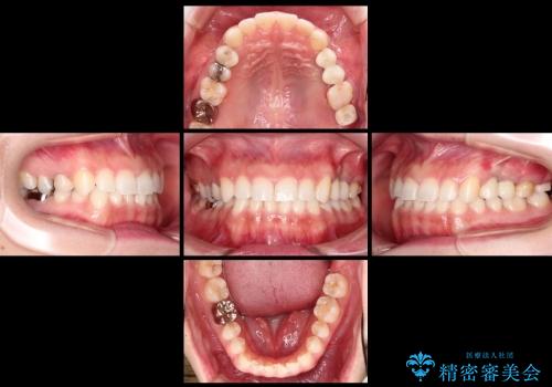 前歯の矯正 / 奥歯のインプラント治療の治療後