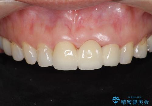 [歯肉の移植] 審美性を改善した前歯ブリッジ治療の治療後