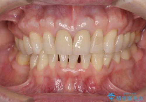 [感染根管治療] 根管治療を伴った前歯部精密審美治療の治療後