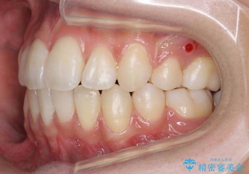 前歯のがたがた　根の短い歯を優先的に抜歯の治療後