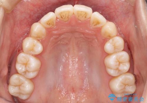前歯のがたがた　根の短い歯を優先的に抜歯の治療後