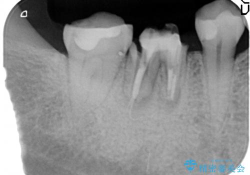 下顎奥歯のインプラントの治療前