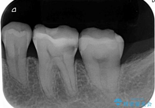 [虫歯の再発] 精密セラミック治療の治療前