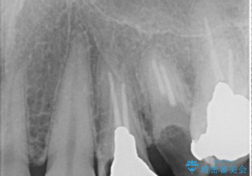 前歯の矯正 / 奥歯のインプラント治療の治療前