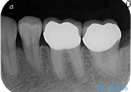 [虫歯の再発] 精密セラミック治療の治療後