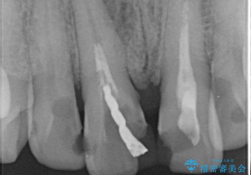 [感染根管治療] 根管治療を伴った前歯部精密審美治療の治療前