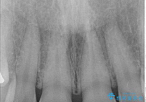 前歯の矯正 / 奥歯のインプラント治療の治療前