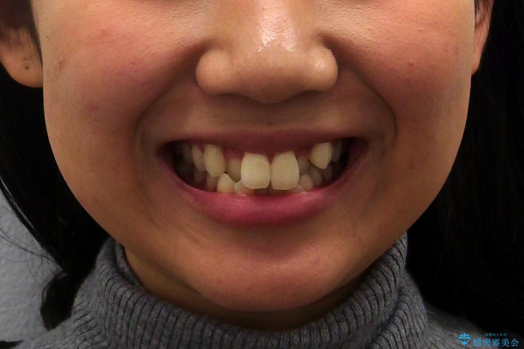前歯のがたがた　根の短い歯を優先的に抜歯の治療前（顔貌）