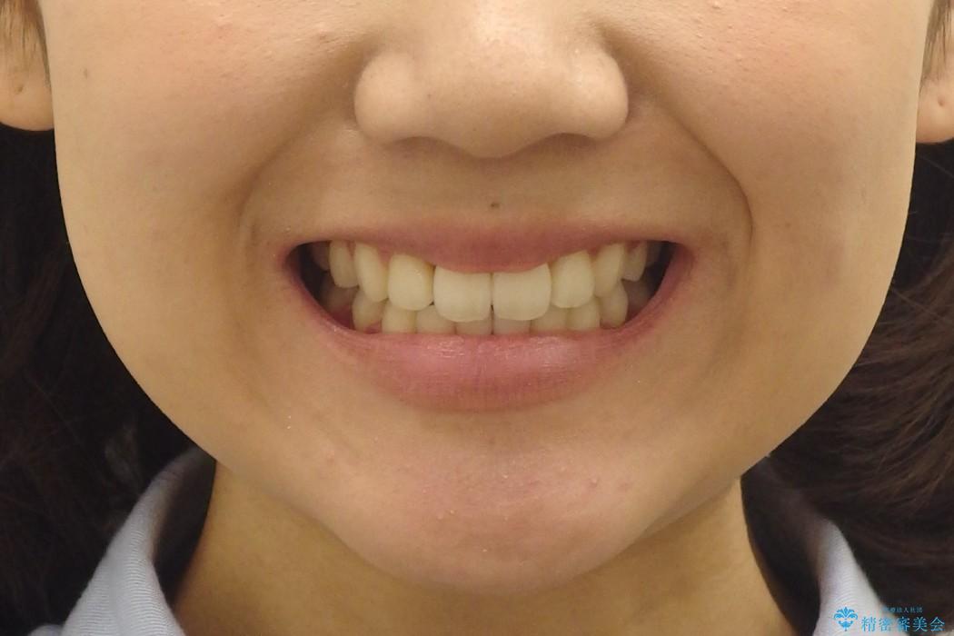 前歯のがたがた　根の短い歯を優先的に抜歯の治療後（顔貌）