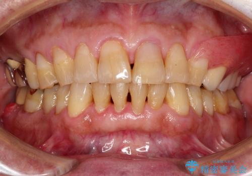 セラミックの被せ物と自費の入れ歯による咬合の改善の治療後